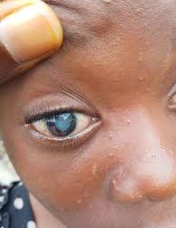 Hope for Favour: Disfigured 13-Year-Old Girl in Imo to Undergo Eye Surgery After Abuse